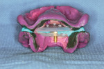 Recorded and joined impression trays removed from the mouth without being separated.