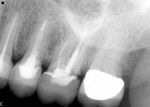 Radiograph of the fractured crown; note the inadequate post-and-core placement.