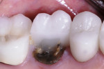 Fractured crown on an endodontically treated tooth.