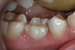 Ankylosed mandibular right primary second molar with mesial caries lesion.