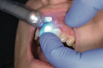 The crowns on Nos. 8 and 9 were stabilized with
finger pressure and tack-cured for 5 seconds on both the buccal and lingual surfaces with a monowave LED curing light.