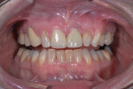 The final restorations on Nos. 8 and 9 immediately after cementation with Calibra Universal Self-Adhesive Resin Cement.