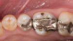 Tooth No. 19 had an mesio-occlusal-distal amalgam with a fractured disto-lingual cusp. The tooth showed signs of erosion and functional wear facets, making it an ideal candidate for a high-strength ceramic like zirconia.