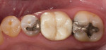 The final restoration cemented in the mouth.