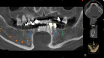 CBCT enabled planning implant placement at sites that would best distribute the occlusal load.