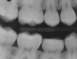 Bitewing and periapical films at 14 months.