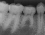 Bitewing and periapical films at 14 months.