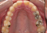 Figure 3  Occlusal view of the maxillary arch showing wear of the incisors through to dentin.