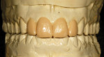 Figure 4  The diagnostic wax-up showing possible dimensions of the proposed incisor restorations and their interplay with the mandibular teeth when the mandible is in lateral excursive movements.