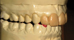 Figure 5  The diagnostic wax-up showing possible dimensions of the proposed incisor restorations and their interplay with the mandibular teeth when the mandible is in lateral excursive movements.
