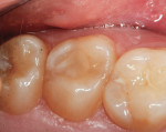 Fig 6. A 3-month postoperative image after placement of bioactive restorative material.