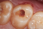 Fig 4. Caries excavation was performed, bringing the completed preparation in close proximity to the pulp, with no pulpal exposure.
