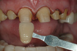 Fig 13. Preparations for the definitive
porcelain restorations with shade of the dentin noted.