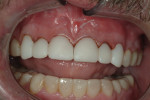 Fig 14. Cemented BIS-GMA temporaries after preparation for porcelain restorations.