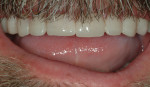Fig 8. After the placement of the provisional
restorations, the smile contour was improved.