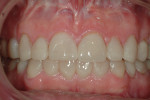 Fig 9. Provisionally restored arches in maximum intercuspation showing the increased tooth length and improved tooth contours.
