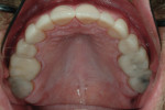 Fig 11. Maxillary occlusal view after provisional restorations were placed.