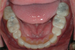 Fig 12. Mandibular occlusal view, showing the care taken to maintain the correct occlusion in the provisional restorations.