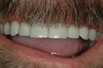 Fig 15. Close-up view of anterior teeth after restoration with porcelain-layered zirconia crowns.