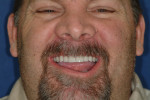 Fig 16. Full smile after the placement of zirconia
crowns on teeth Nos. 6 through 11.