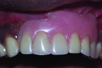 Fig 1. Patient’s initial removable partial denture, from maxillary right lateral incisor to left first premolar.