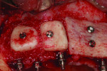 Fig 9. Allogeneic and autogenous bone block grafts fixated to the buccal ridge with mineralized freeze-dried bone filling the spaces.
