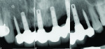Fig 16. Periapical radiographs at 11-year follow-up.
