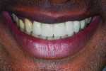 Fig 18. Patient smile line at 11-year follow-up.
