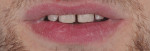 Fig 2. Pre-treatment photograph showing severe erosive decay with esthetic and functional impairments.