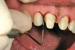 Figure 12  Margin placement on the prepared tooth relative to interproximal alveolar crest verified through 