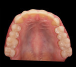 Fig 11. CAD/CAM-fabricated polymer intraoral try-in.