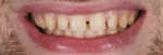 Fig 12. Minimally invasive preparation
design of anterior teeth.