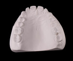 Fig 16. The initial lodged virtual wax-up (Fig 16) was used again to design the final restorations (Fig 17).