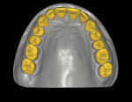 Fig 17. The initial lodged virtual wax-up (Fig 16) was used again to design the final restorations (Fig 17).
