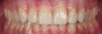 Fig 20. Final treatment outcome
photographs showing significant functional and esthetic improvement.