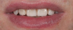 Fig 21. Final treatment outcome
photographs showing significant functional and esthetic improvement.