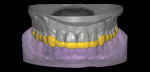 Fig 22. CAD/CAM fabrication of occlusal splint.
