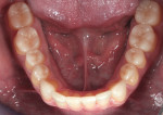 Fig 25. Intraoral photograph of the patient at 1.5-year recall showing stable treatment outcome.