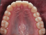 Fig 24. Intraoral photograph of the patient at 1.5-year recall showing stable treatment outcome.