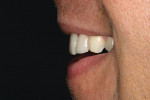 Figure 14  Profile view of provisionals shared with laboratory to convey the importance of the exact incisal edge position for phonetics and lip closure.