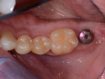 Implant site after 3 months of healing; ready to begin clinical digital workflow.