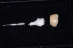 Exploding view of completed eMax crown, zirconia abutment, and implant analog.