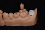 Zirconia abutment seated and oriented on SLA model.