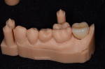 Buccal view of final restoration seated on zirconia abutment and properly oriented on SLA model.