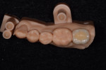 Occlusal view of eMax crown seated on zirconia abutment and SLA model.