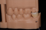 Buccal view of articulated models showing eMax crown seated on zirconia abutment.