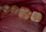 Occlusal view of final restoration luted in the mouth after occlusal adjustment.