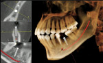 Figure 6  3D data enhancement and implant planning software (pictured on InVivoDental).