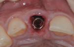After flapless placement, a buccal gap of 2 mm was measured.
