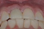 Favorable buccal contours simulating the adjacent natural tooth.